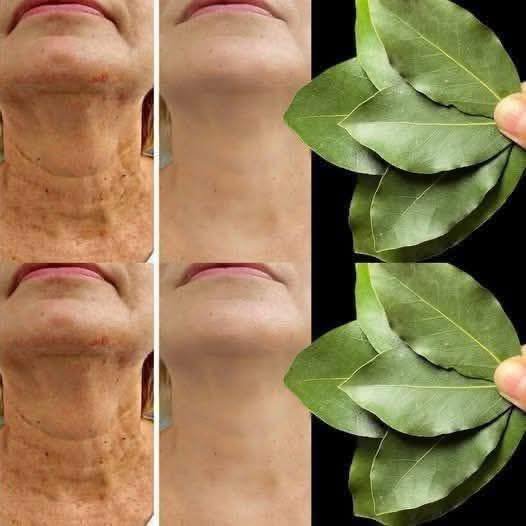 Bay Leaf Is 100,000 Times Stronger Than Botox? | Natural Wrinkle Eraser Even at Age 70!