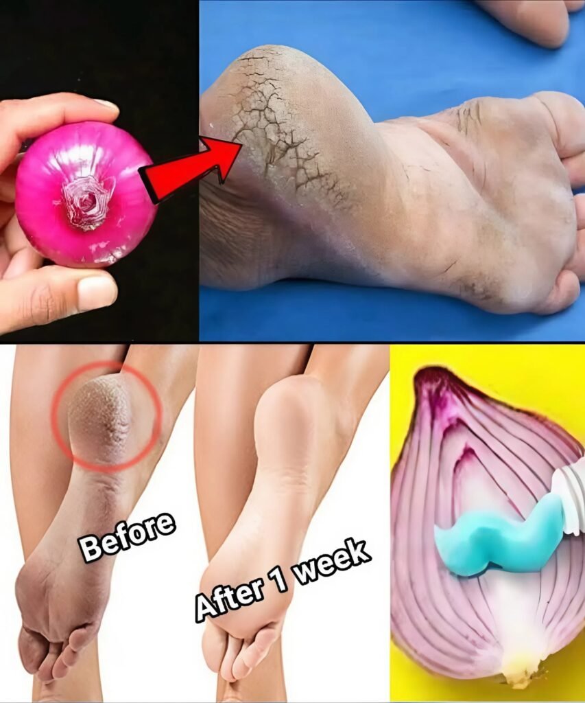 5 Proven Natural Remedies for Cracked Heels (You’ll Wish You Tried Sooner)