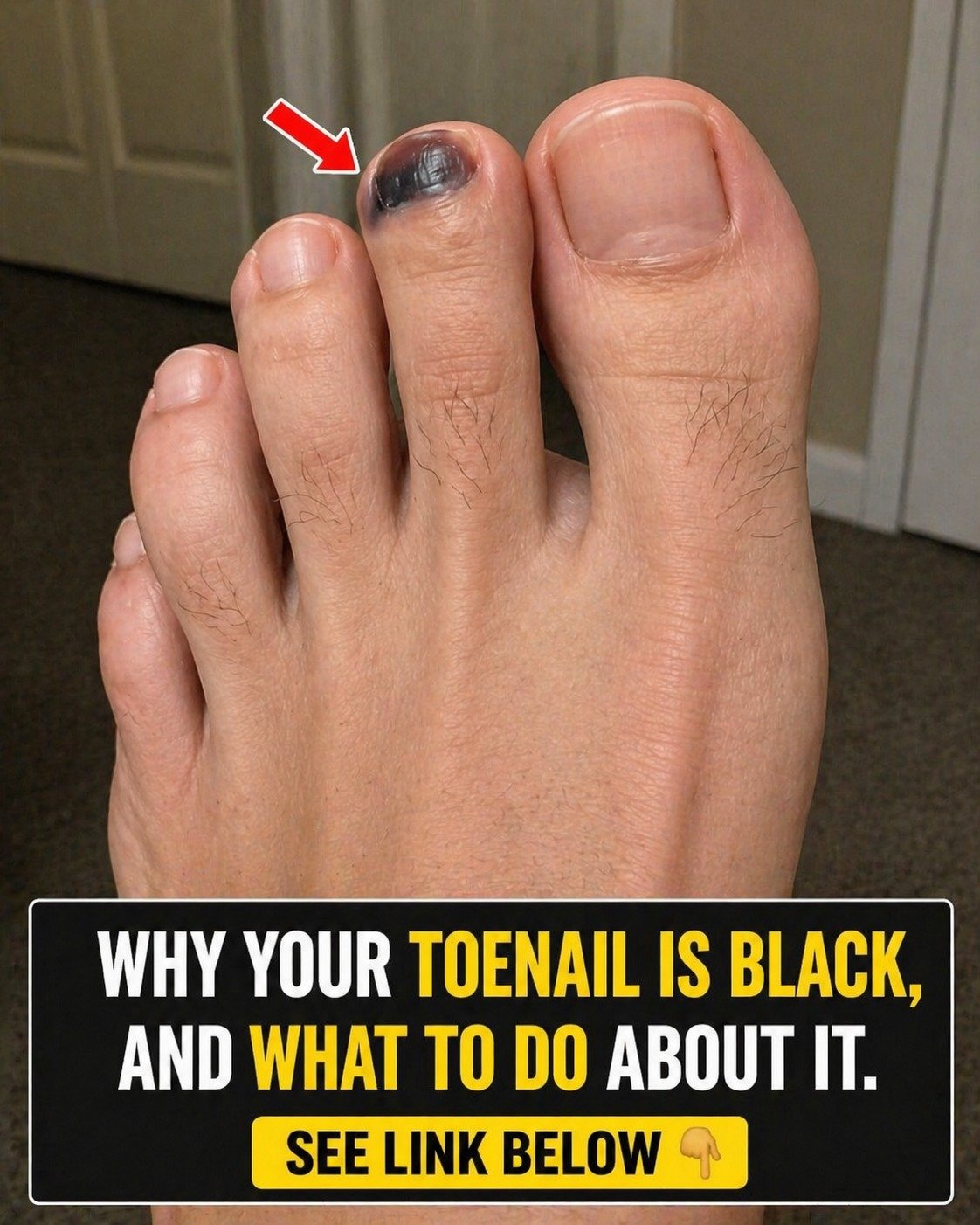 Why Your Toenail Is Black, And What To Do About It