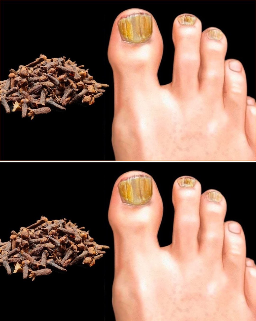 Nail Fungus Remedy: Easy Home Treatments