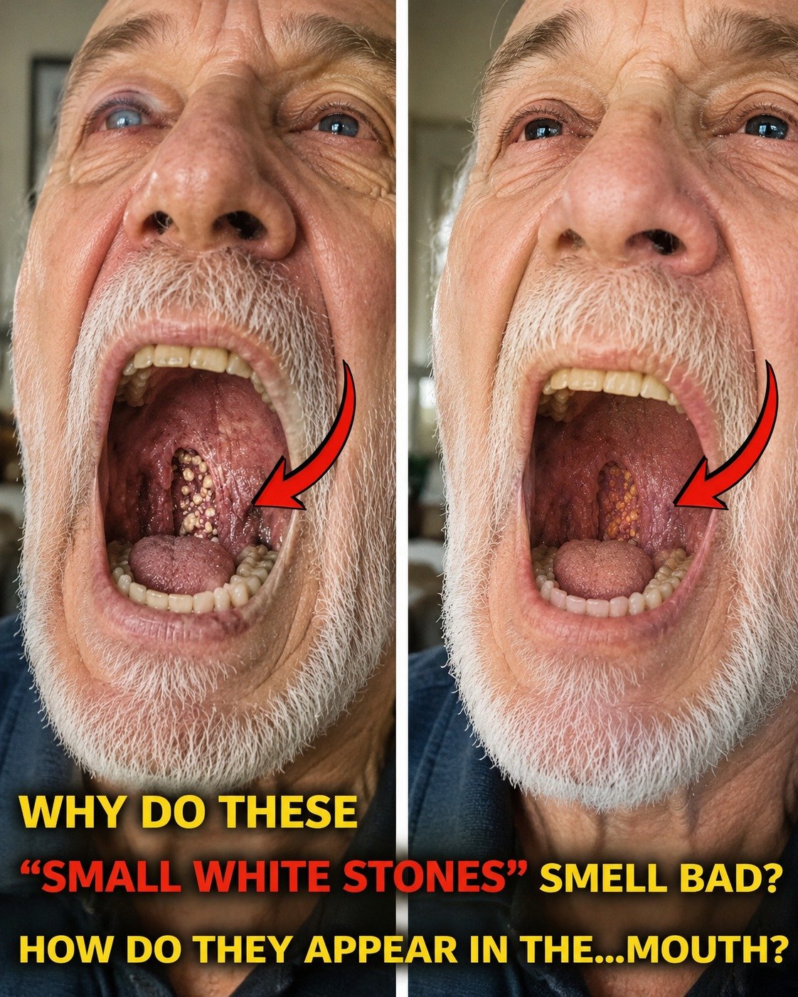 Small White Tonsil Stones Trigger Bad Breath — Here’s Why