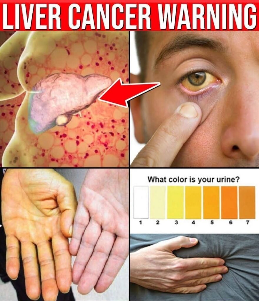 Viral “Liver Cancer Warning” Image: What the Signs Really Mean