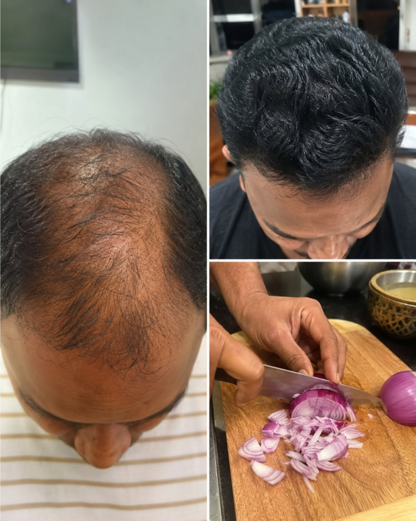 Onion Juice for Extreme Hair Growth: The Sulfur Shock Your Scalp Can’t Ignore