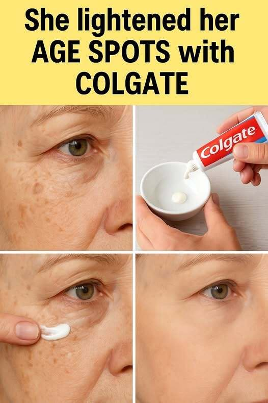 Lighten Age Spots Naturally with Colgate!