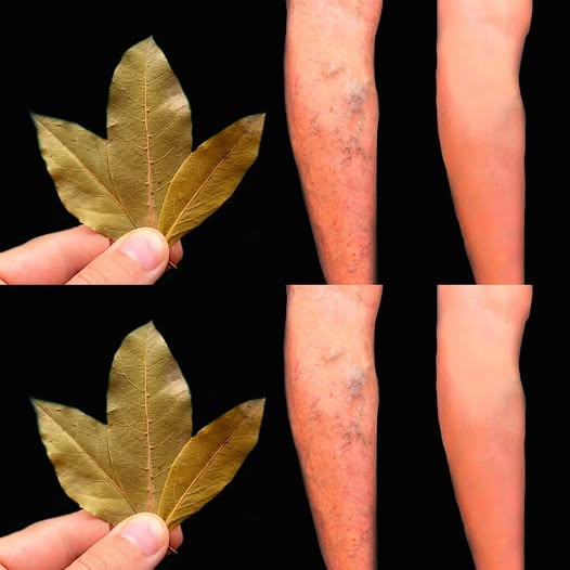 Unbelievable! Get Rid of Varicose Veins with Bay Leaf & Baking Soda – This Treasure Should Be in Every Home!