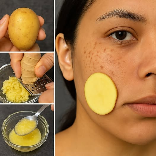 Brighten Your Skin Naturally with Potatoes and Ginger