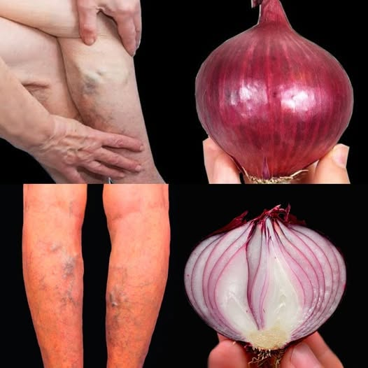 Unbelievable!  It’s a Varicose Vein Killer! Red Onion’s Top 5 Home Recipes That Support Vein Health