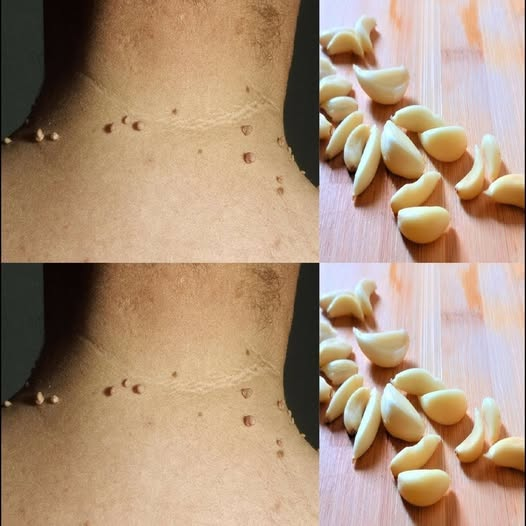 Remove Skin Tags Naturally | Easy Home Remedy with Garlic