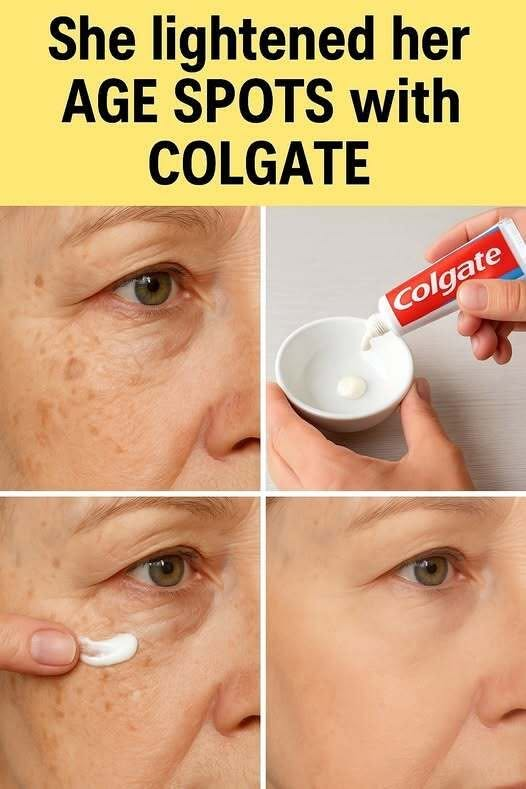 Natural Remedies for Age Spots Using Colgate Toothpaste