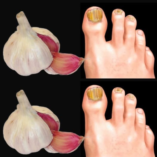 Instantly Targets Nail Fungus Like an Eraser – The Power of Garlic!
