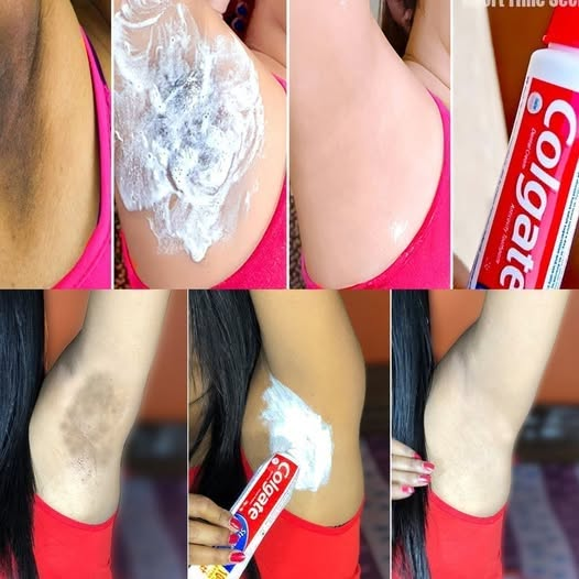Revitalize Your Underarms with Toothpaste: A Surprising Whitening Solution