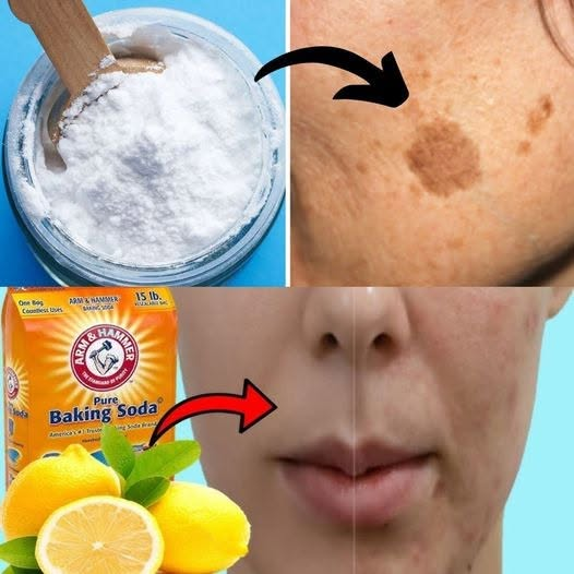 BAKING SODA REMOVES AGE SPOTS, ACNE, BLACKHEADS! Here’s What You Need to Do…