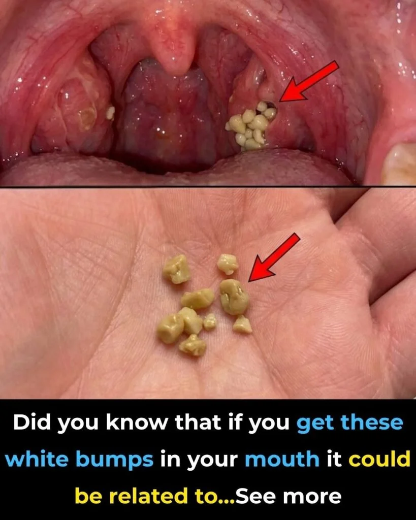 White or Yellow Bumps on Your Tonsils? Here’s What You Should Know About Tonsil Stones