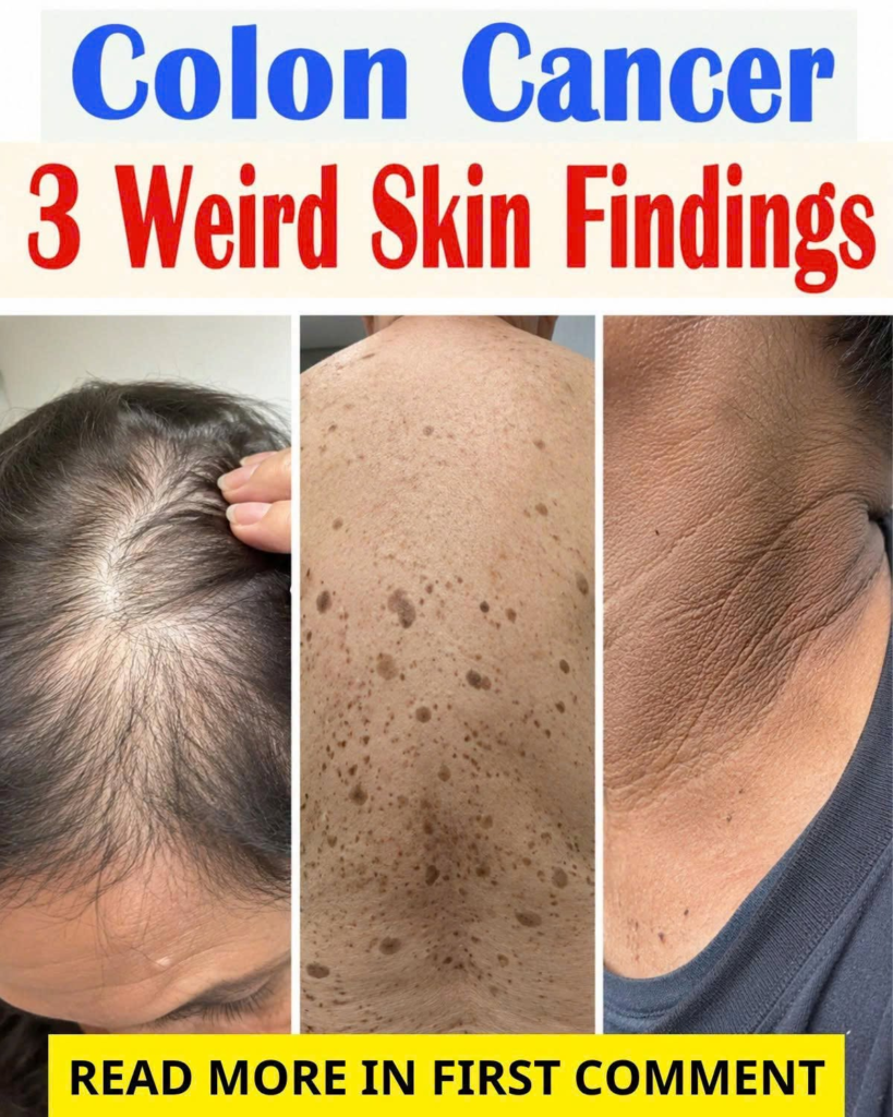 Colon Cancer Signs on the Skin: 3 Warning Changes You Shouldn’t Ignore