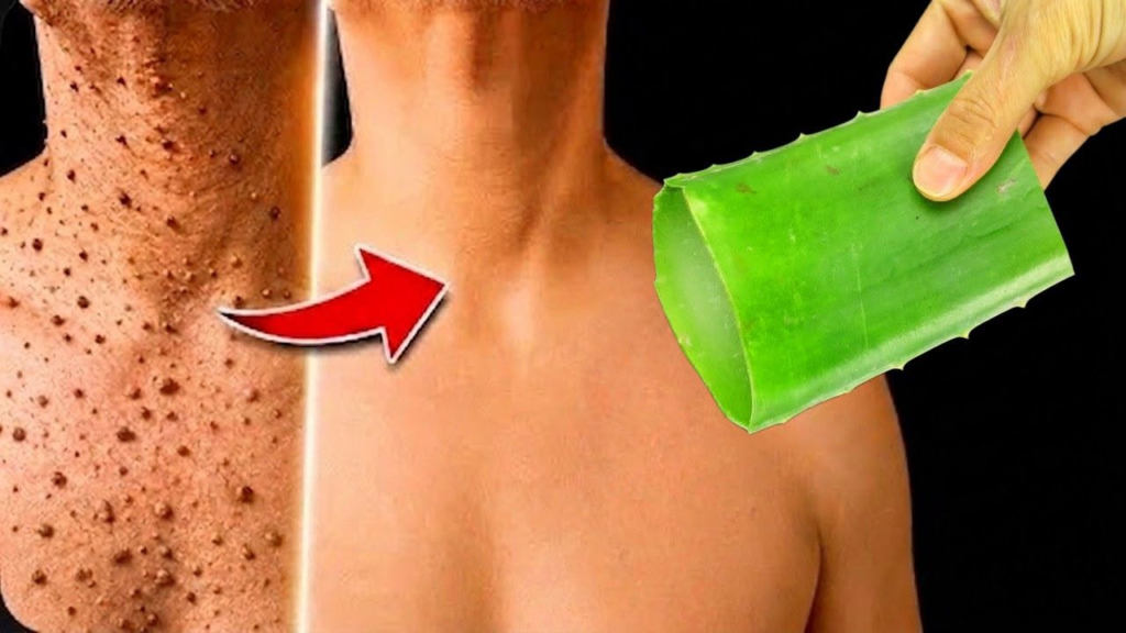 Have you ever noticed a small, unwanted skin growth and wished for a simple, natural way to address it?