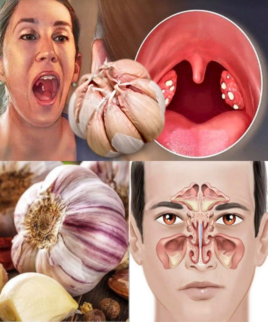 Garlic Eliminates Infections: Sinusitis, UTIs, Sore Throat