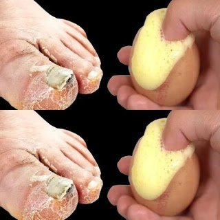Cure Toenail Fungus for Less Than $1 in Under 1 Minute – The Egg Remedy