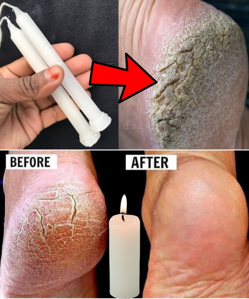 How to Soften Cracked Heels Overnight