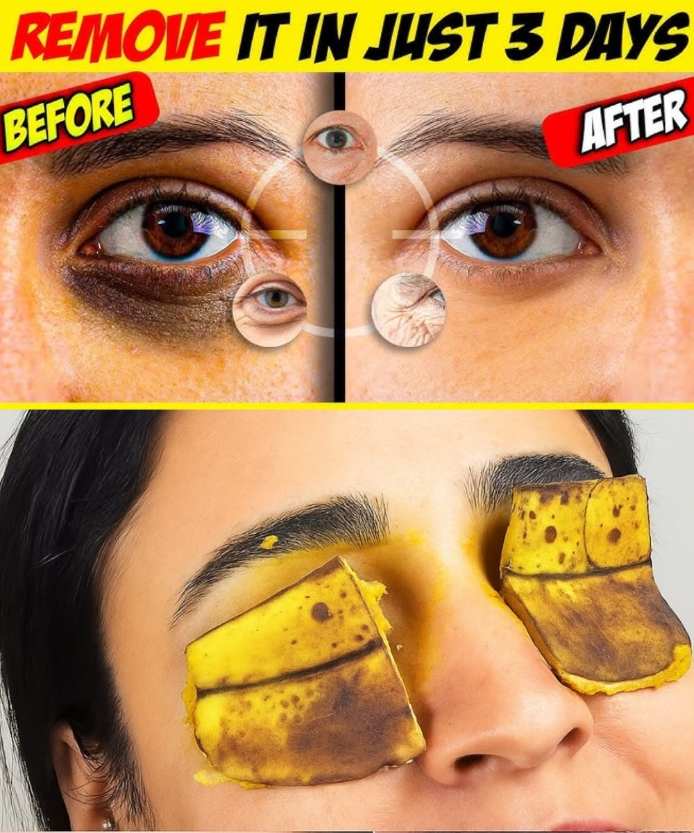 Banana Peel for Dark Circles: I Tried It—And Here’s What Really Happened