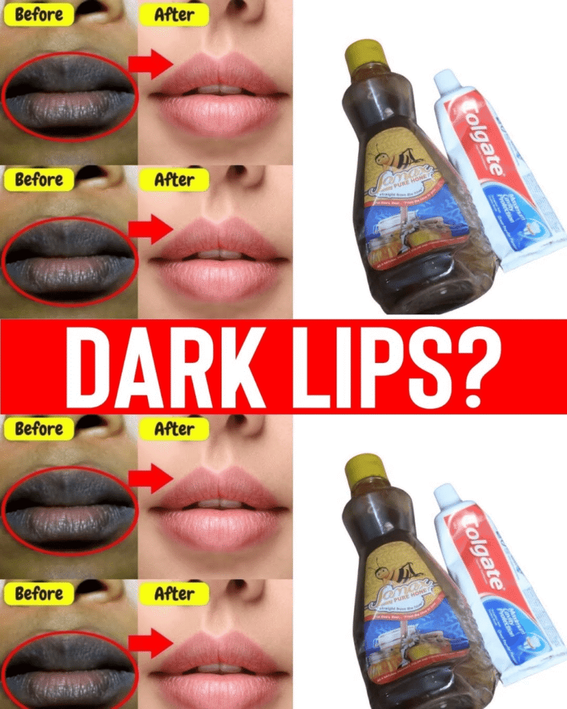 Dark Lips?  Try This Simple Home Remedy with Honey & Toothpaste!