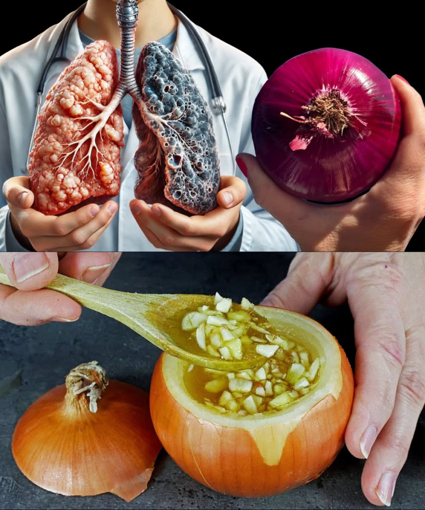 The Onion Antibiotic: A Powerful Natural Remedy for Cough, Bronchitis, and Pneumonia