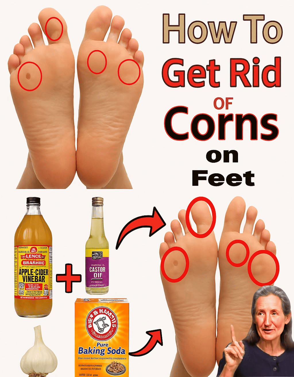 Say Goodbye to Corns and Calluses: 14 Proven Home Remedies That Really Work!