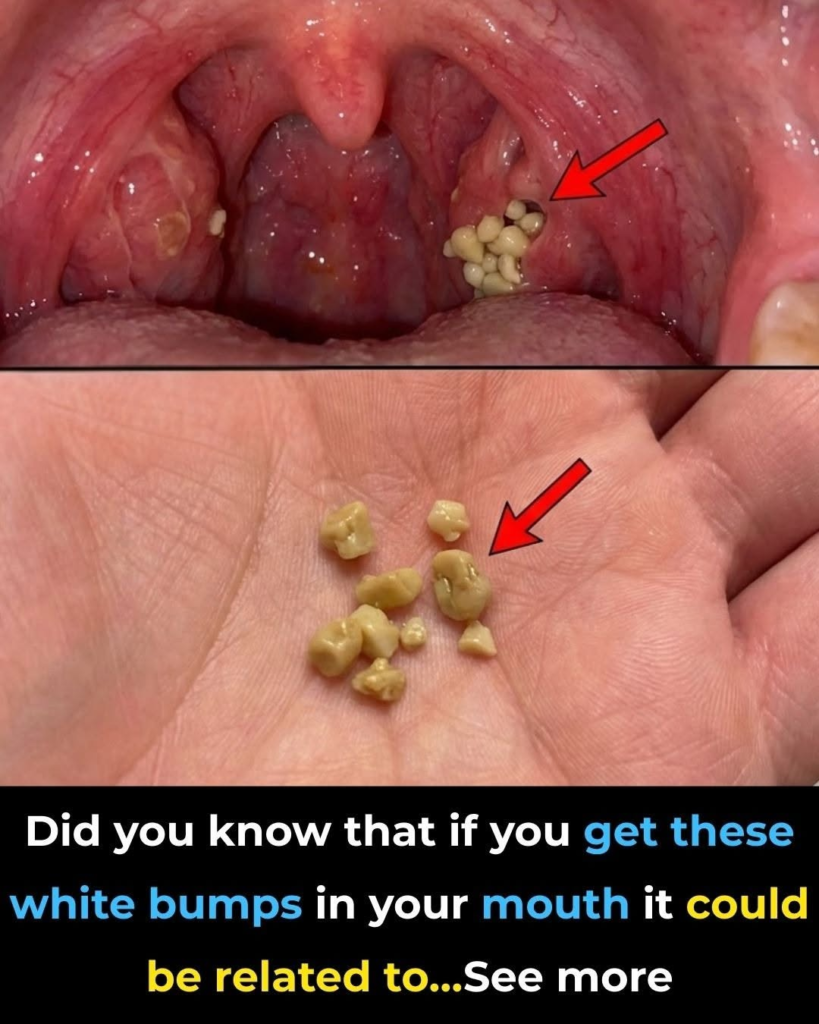 Here’s what you need to know about tonsil stones – the weird pimple-like growths in your throat