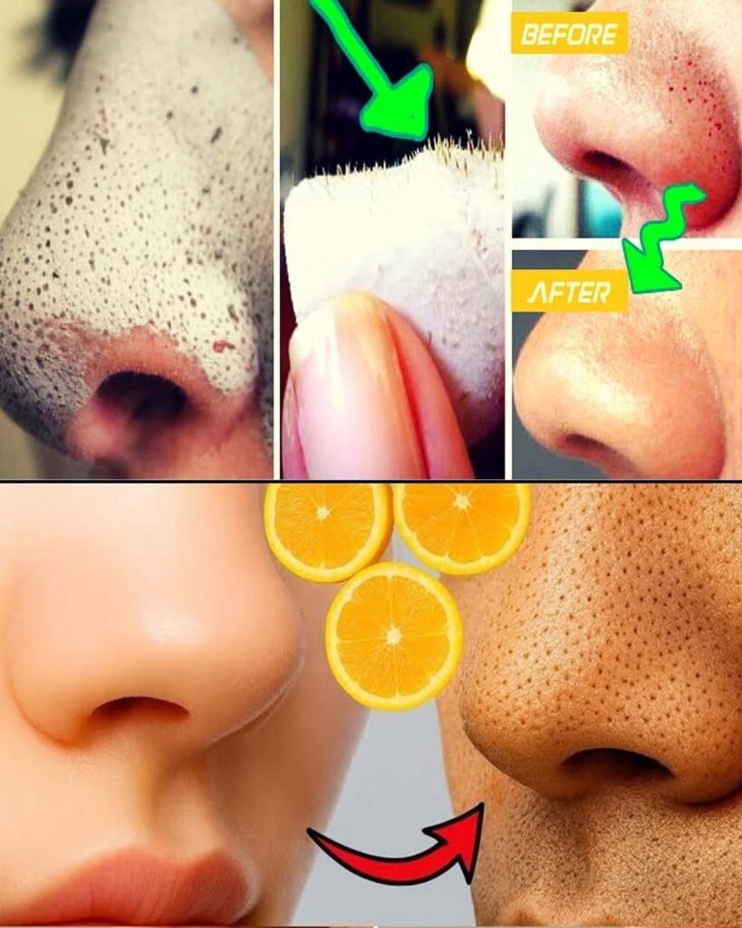 How to Remove Skin Tags at Home: Fast and Easy Natural Skin Tag Removal
