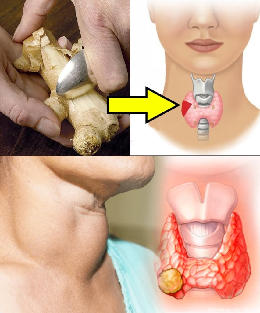 19 Foods to Avoid If You Have Hypothyroidism or Thyroid Problems
