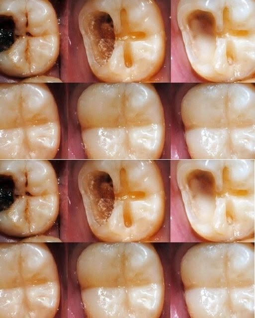 Natural Ways to Support Healthy Teeth & Fight Early Decay