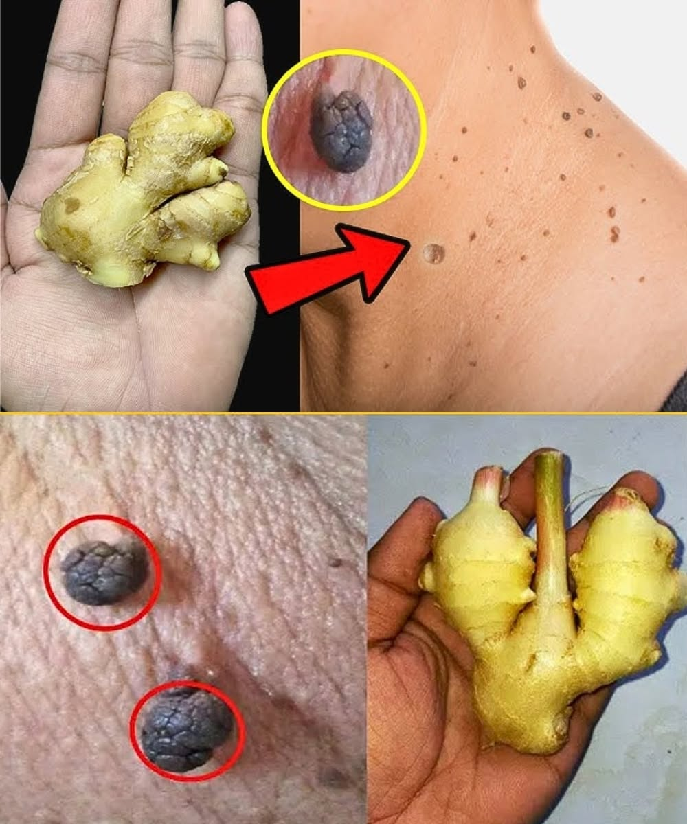 How I Naturally Removed Skin Tags at Home with Lemon & Ginger