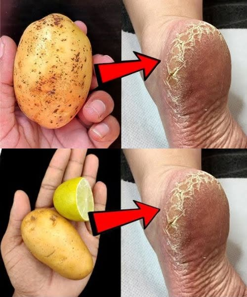 Soothe Cracked Heels Naturally—with Just a Potato!