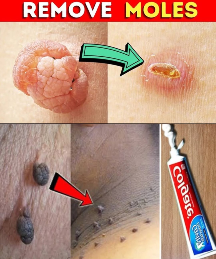 Say Goodbye to Warts and Skin Tags Naturally: A Simple Remedy That Really Works