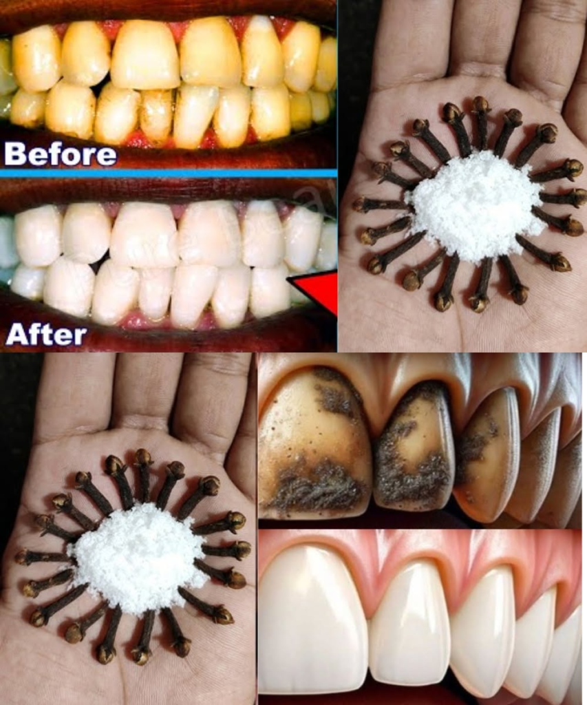 Unlock the Secret to Healthier Teeth with the Oral Care Benefits of Chewing Cloves Daily