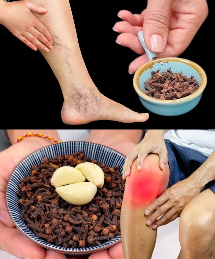 Leg Pain, Rheumatism, Varicose Veins, Arthritis – Natural Remedy with Cloves & Garlic!