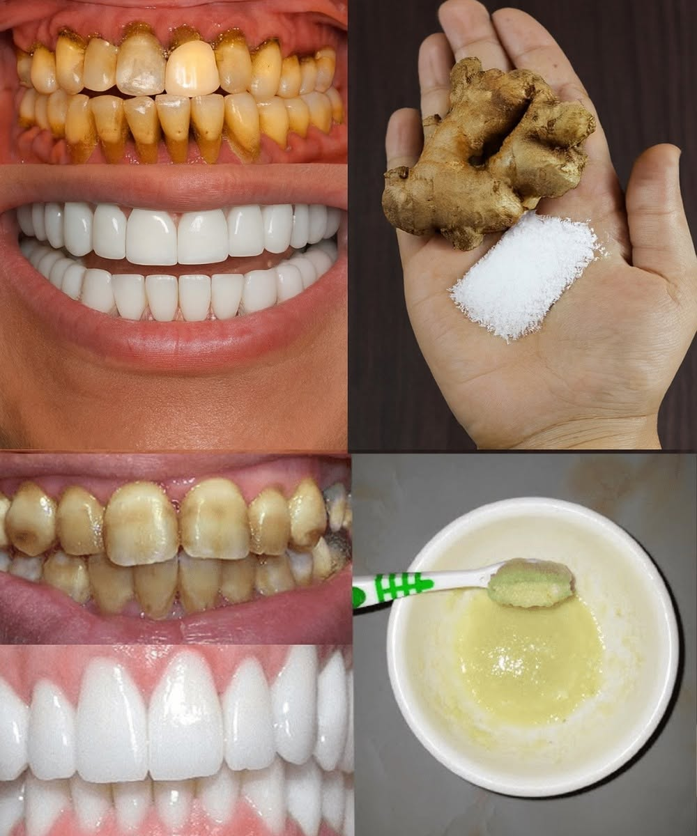 Ginger and Salt for Teeth Whitening: Natural Smile Hack or Just a Trend?