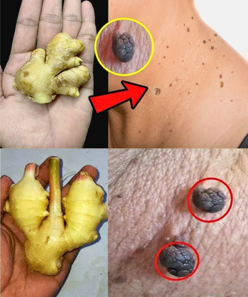 How I Naturally Removed Skin Tags at Home with Lemon & Ginger