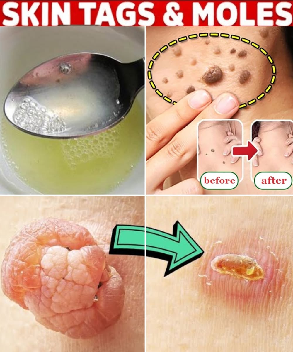Plantar Warts and Skin Tags Disappear Naturally—Try This Overnight Remedy