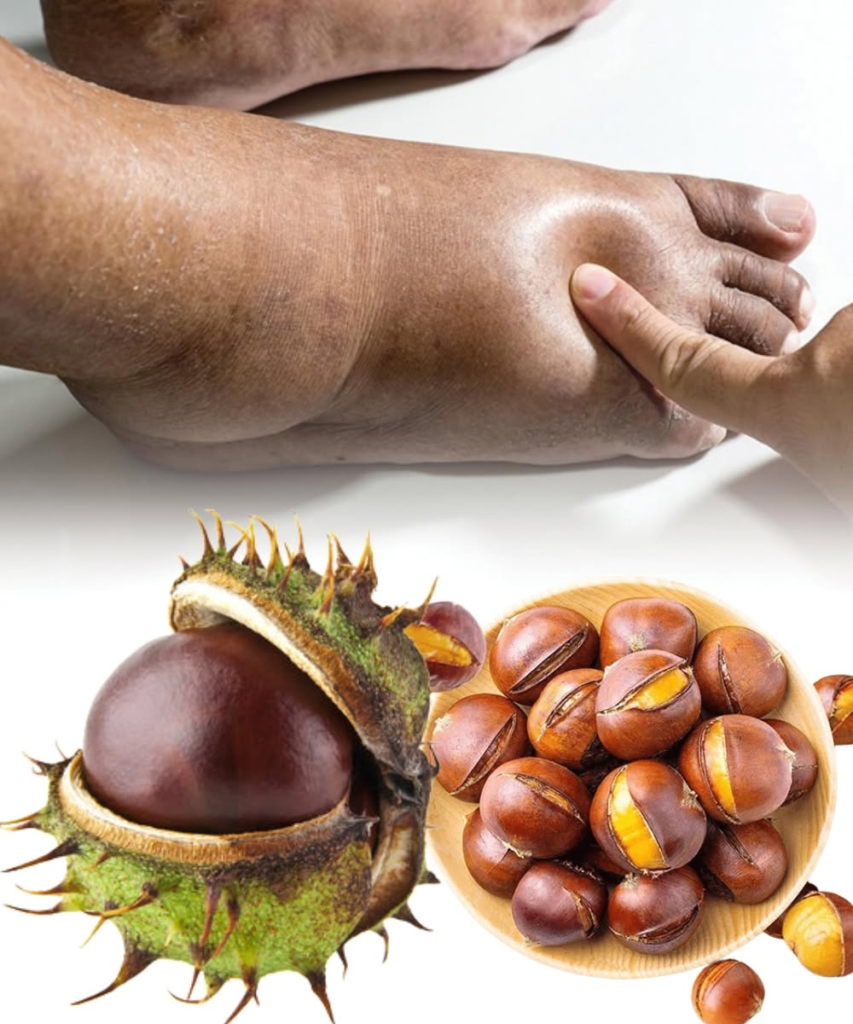 Horse Chestnut: The Strongest Natural Remedy for Swollen Legs and More…
