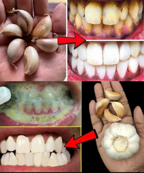 Improve Your Oral Health Naturally with Garlic