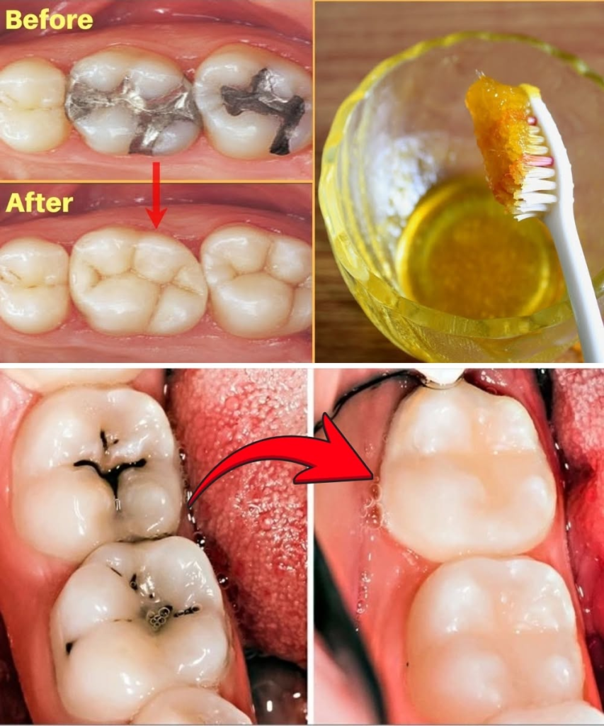 How to Get Rid of Tooth Cavity Naturally: The Most Effective Home Remedy to Reduce Pain Fast