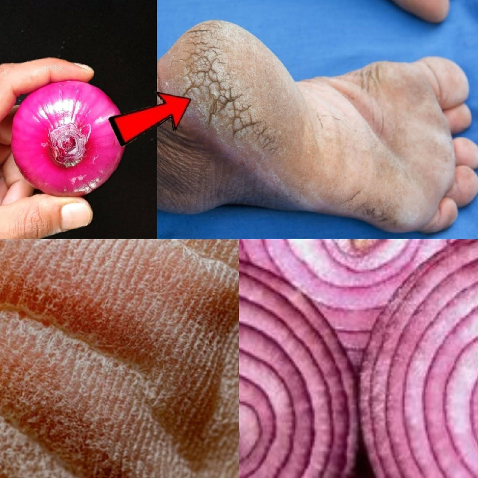 Remove Cracked Heels and Get Beautiful Feet Permanently: Magical Remedy with Red Onion