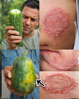 9 Powerful Home Remedies to Get Rid of Fungal Infection (Daad, Khaj, Khujli) Fast